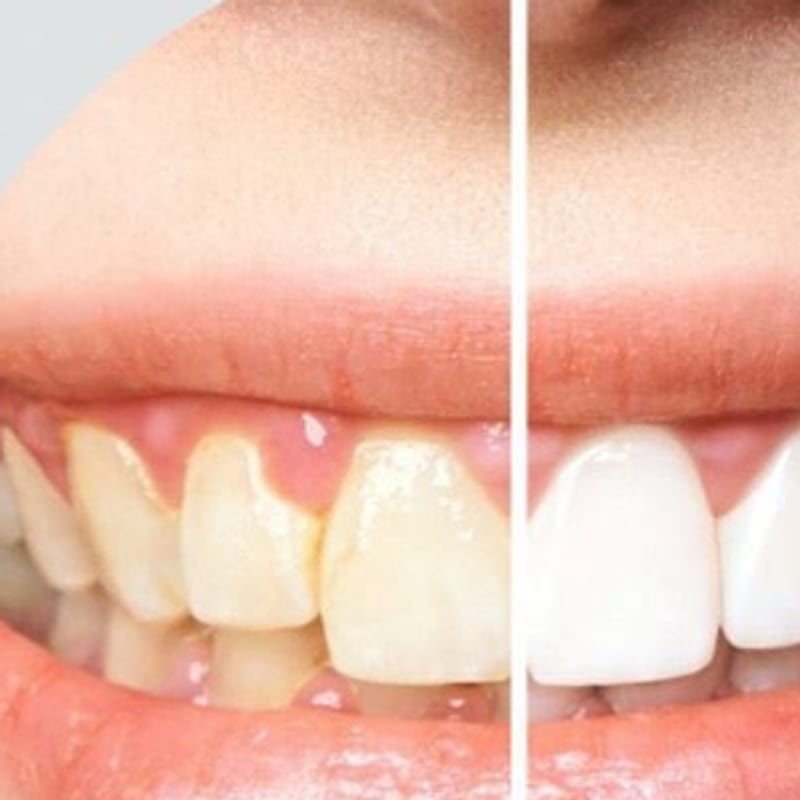 Limpieza dental